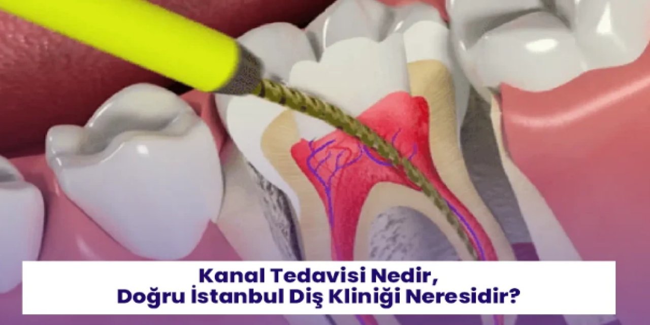 Kanal Tedavisi Nedir, Doğru İstanbul Diş Kliniği Neresidir?