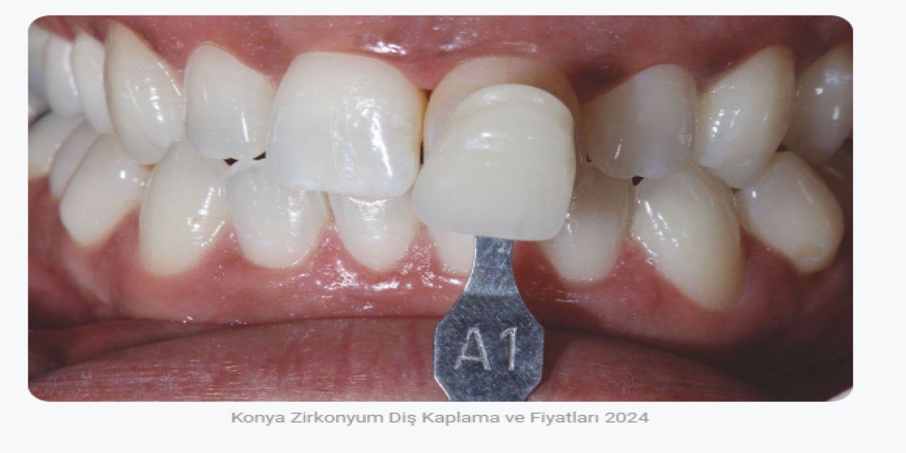 Zirkonyum Kaplama ile Doğal ve Estetik Gülüşler
