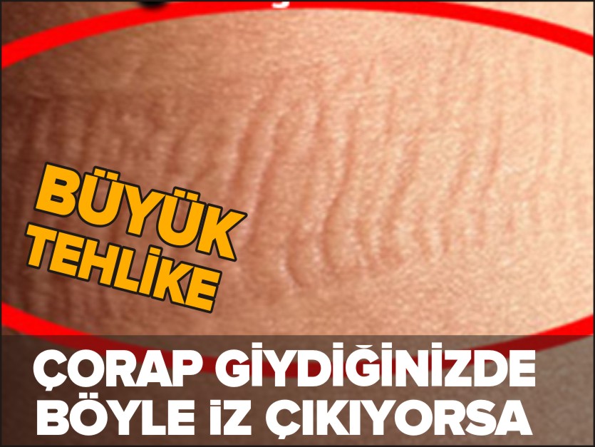 ÇORAP GİYDİĞİNİZDE BÖYLE BİR İZ ÇIKIYORSA BÜYÜK TEHLİKE!