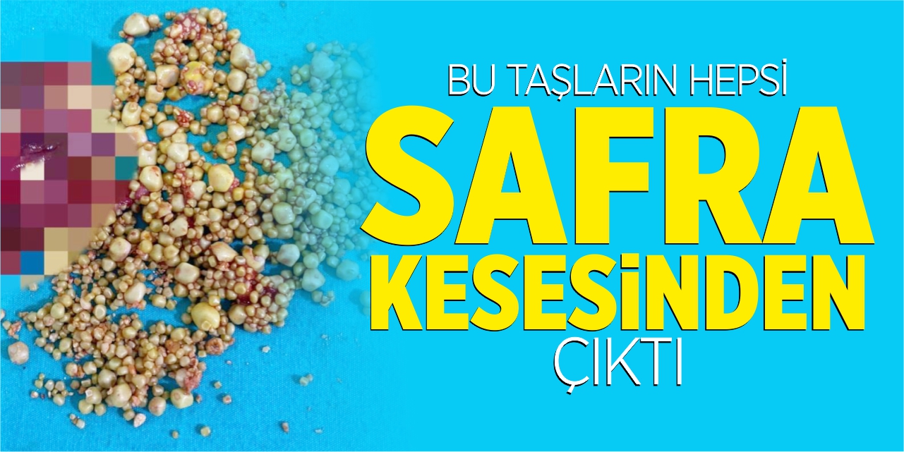 76 yaşındaki hastanın safra kesesinden bin 284 taş çıktı