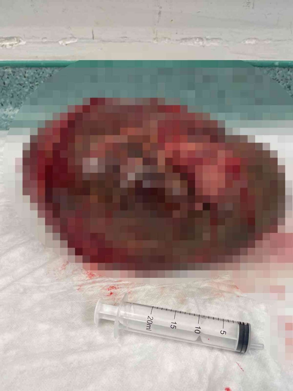 Karın ağrısı ve şişkinlik şikâyetiyle hastaneye gitti, gerçeği öğrenince şoke oldu