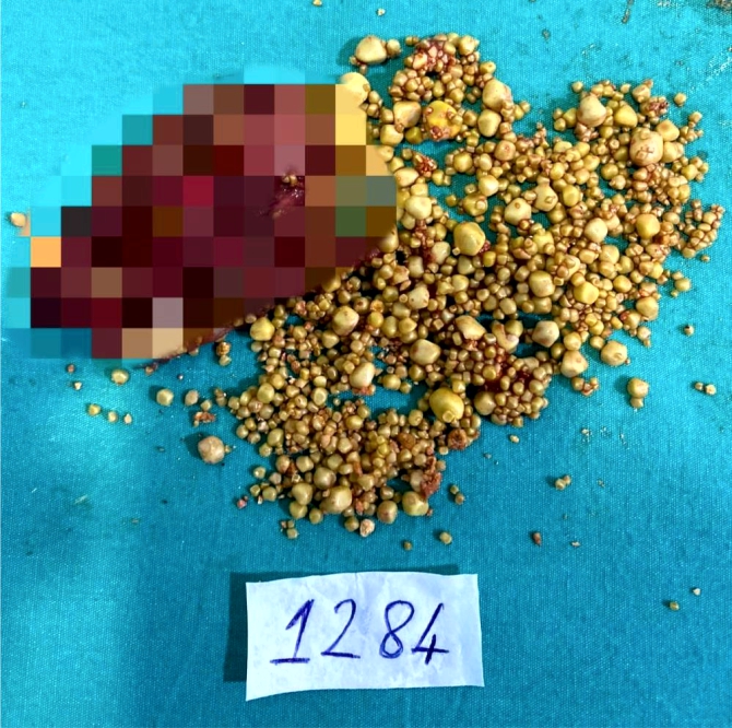 safra-kesesinden-1284-tane-tas-cikti1.jpg