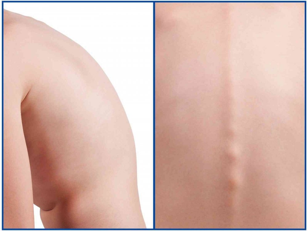 Ebeveynlerin dikkati, çocuklarda görülen skolyozun önüne geçiyor