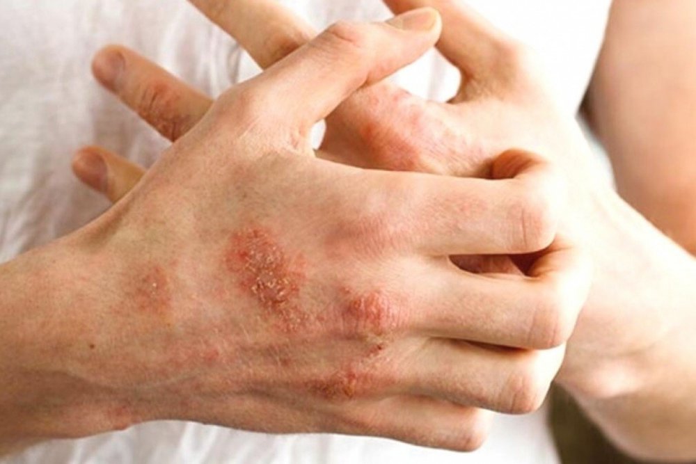 Bu cilt hastalıkları en çok kış mevsimini seviyor!