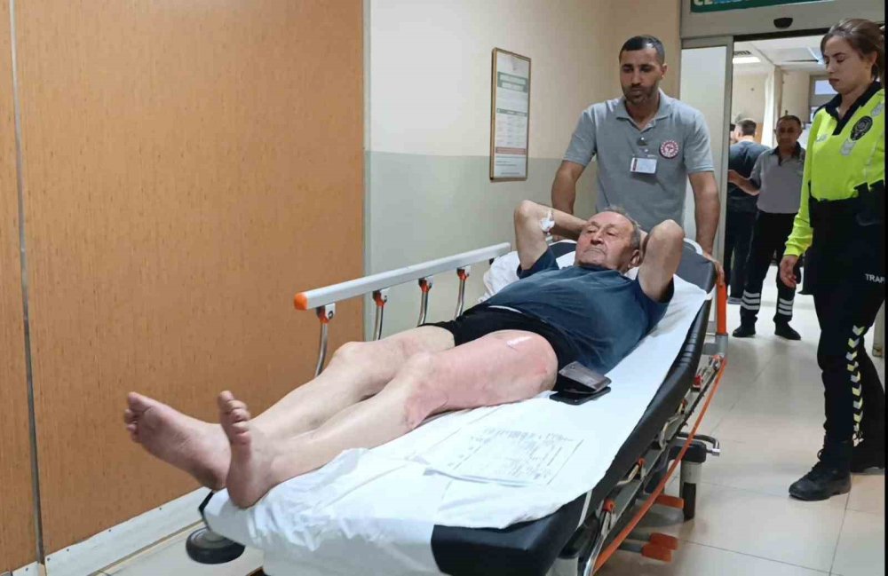 Üzerine Kaynar Su Döküldü
