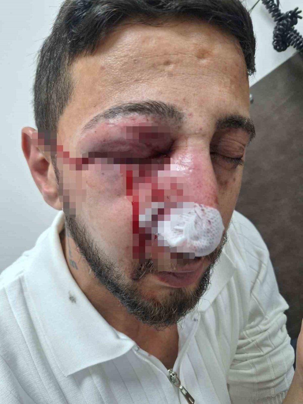 Düğün Eğlencesi Kabusa Döndü: Sağ Gözünden Oldu