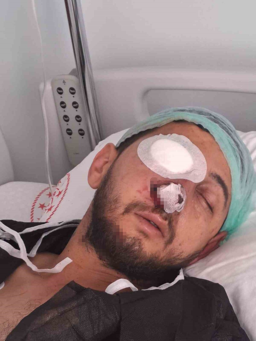 Düğün Eğlencesi Kabusa Döndü: Sağ Gözünden Oldu