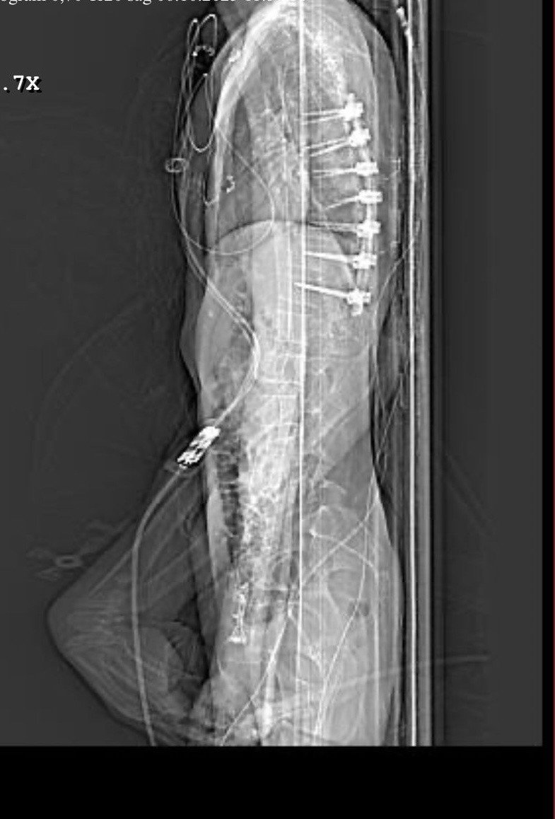 Feci Kazada Ağır Yaralanan Motosiklet Sürücüsünün Babası Konuştu