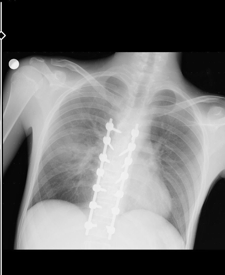 Feci Kazada Ağır Yaralanan Motosiklet Sürücüsünün Babası Konuştu