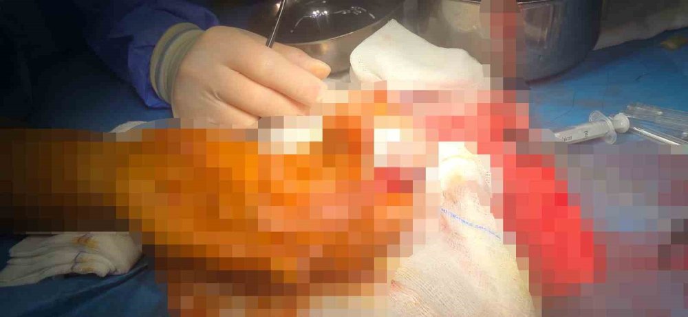 Kopan Parmağını Buz Poşetine Koyup Türkiye’ye Geldi