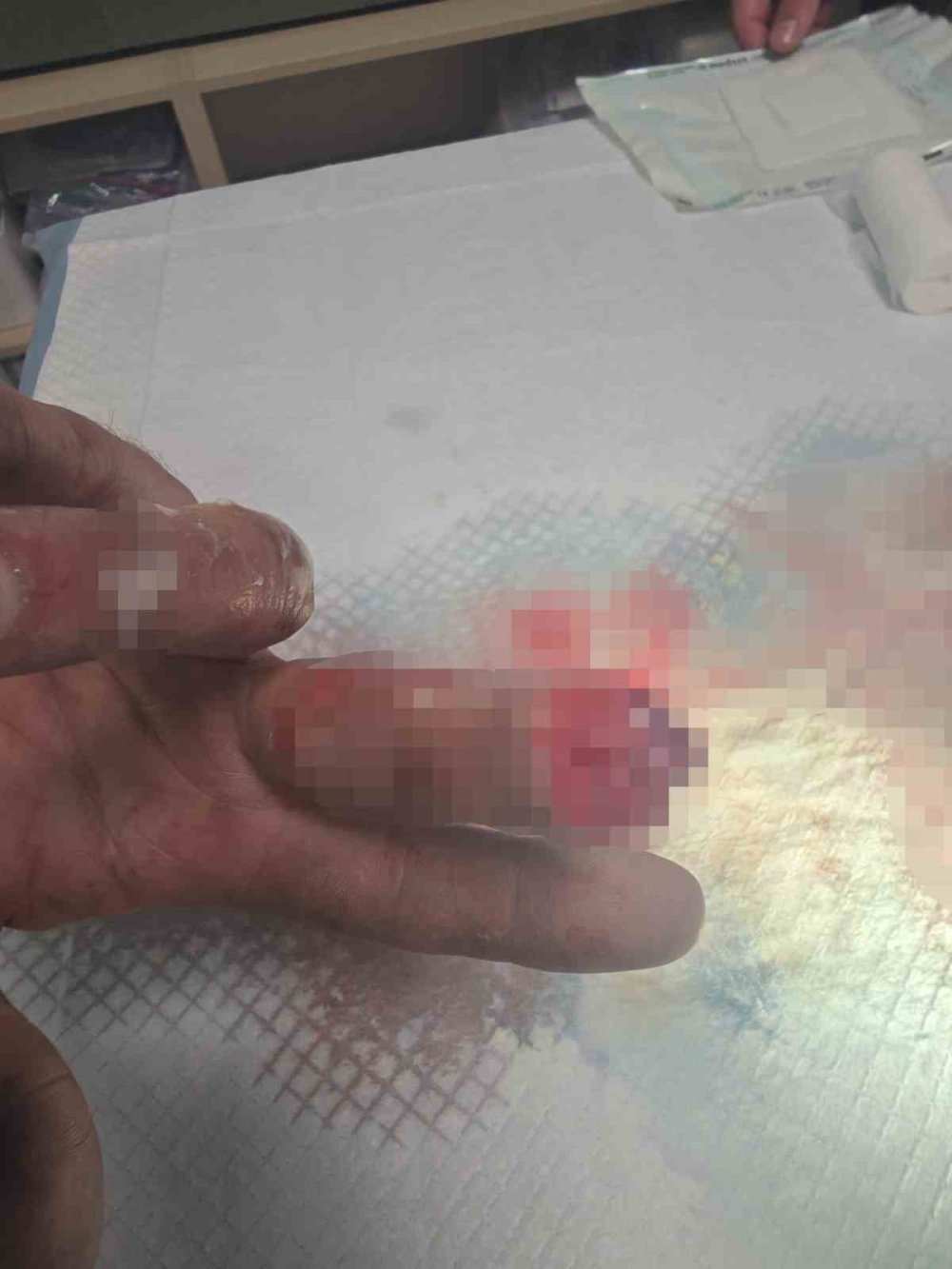 Kopan Parmağını Buz Poşetine Koyup Türkiye’ye Geldi