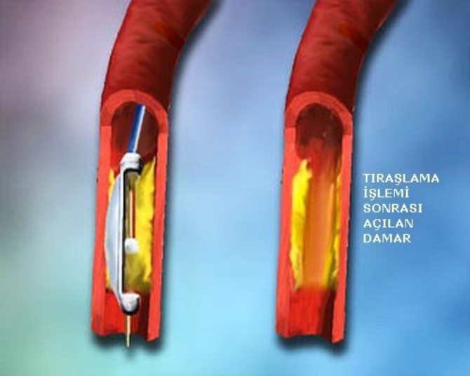 damar-tikanmasina-ameliyatsiz-tedavi-3.jpg